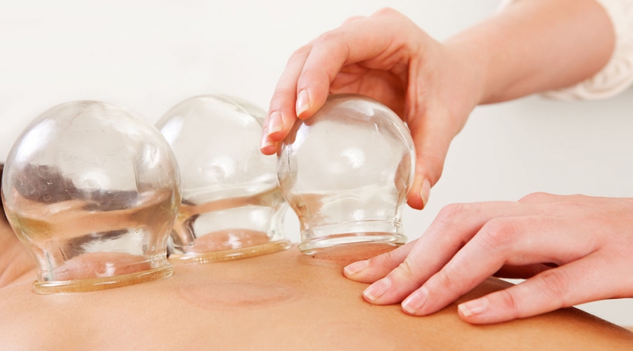 Cupping (Myofascial Decompression)